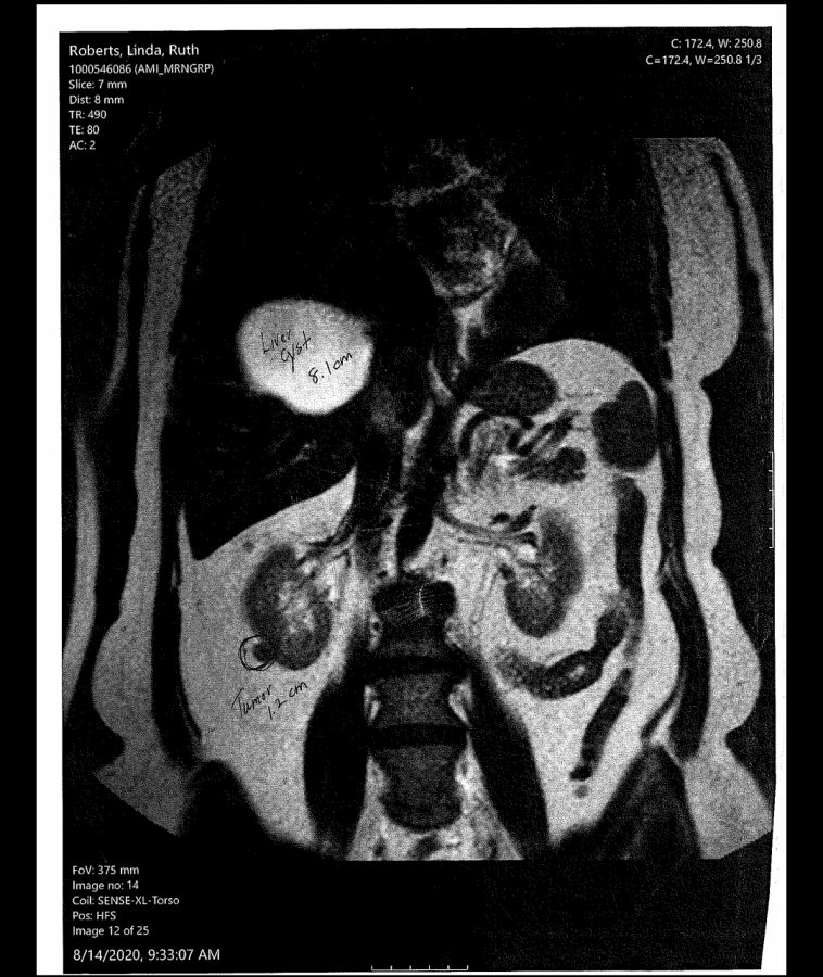 The MRI scan from August 14th shows Linda Roberts tumor and cyst.